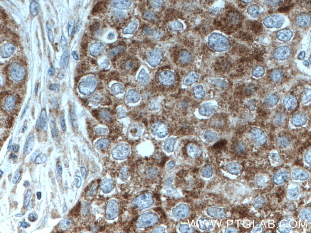 IHC staining of human breast cancer using 66595-1-Ig