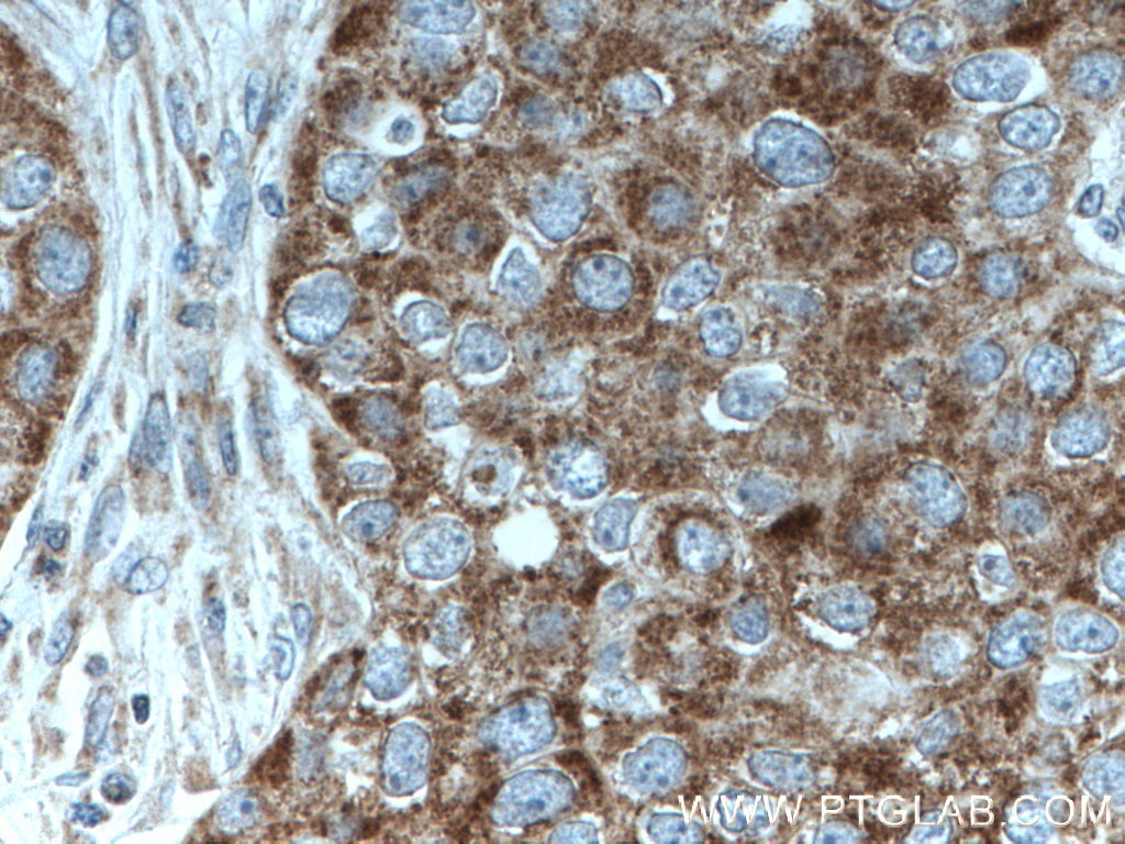 Immunohistochemistry (IHC) staining of human breast cancer tissue using MRPL23 Monoclonal antibody (66595-1-Ig)