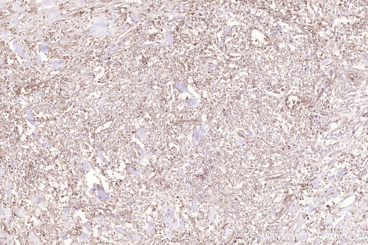 Immunohistochemistry (IHC) staining of human colon cancer tissue using MRPL23 Monoclonal antibody (66595-1-Ig)