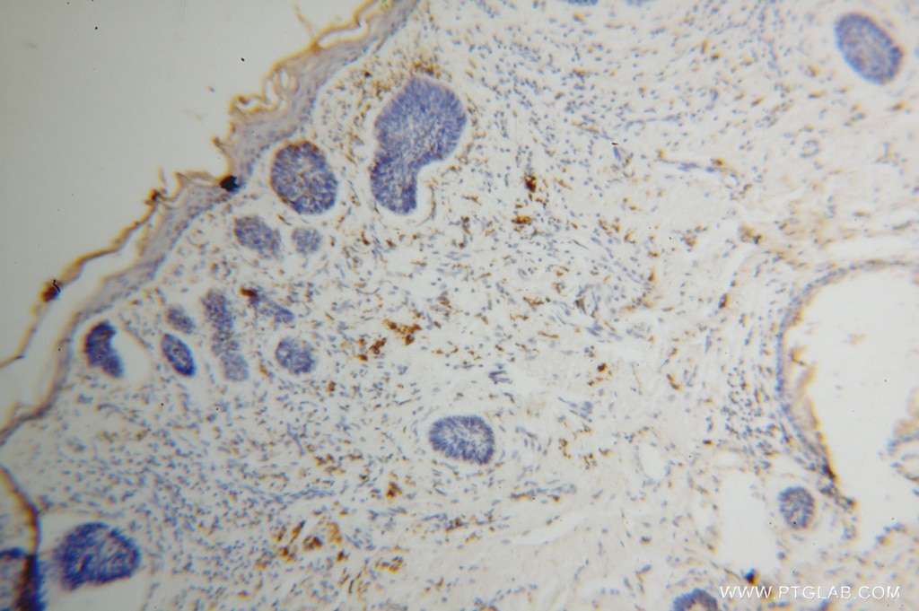 Immunohistochemistry (IHC) staining of human skin cancer tissue using MRPL27 Polyclonal antibody (14765-1-AP)