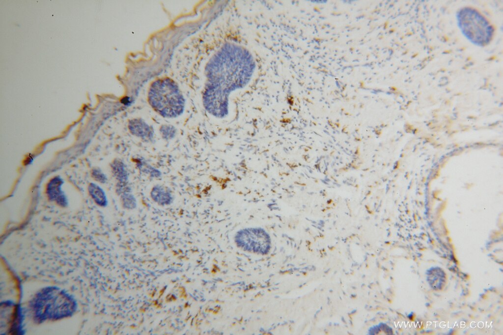 IHC staining of human skin cancer using 14765-1-AP