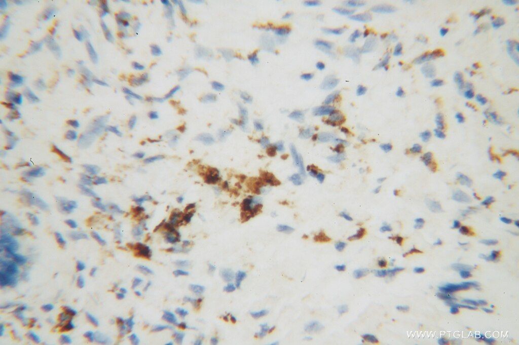 Immunohistochemistry (IHC) staining of human skin cancer tissue using MRPL27 Polyclonal antibody (14765-1-AP)