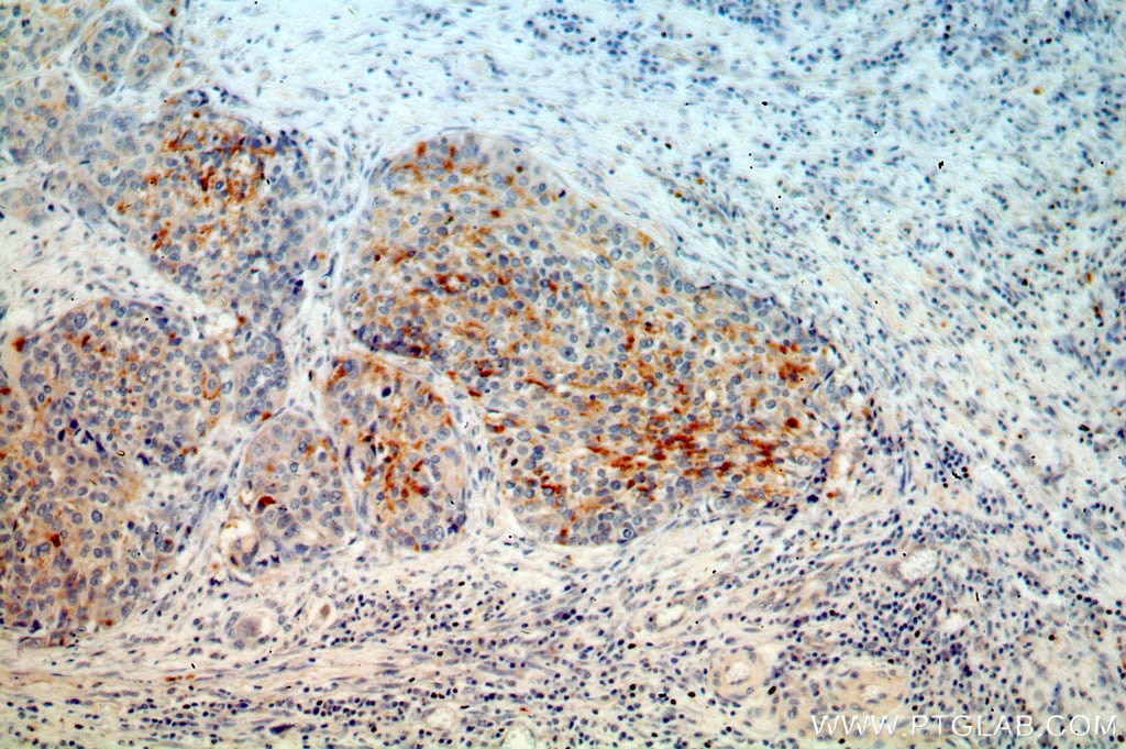 Immunohistochemistry (IHC) staining of human cervical cancer tissue using MRPL3 Polyclonal antibody (16584-1-AP)