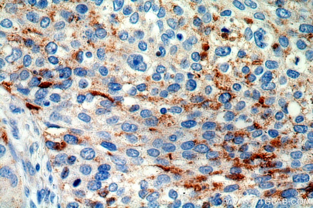 Immunohistochemistry (IHC) staining of human cervical cancer tissue using MRPL3 Polyclonal antibody (16584-1-AP)