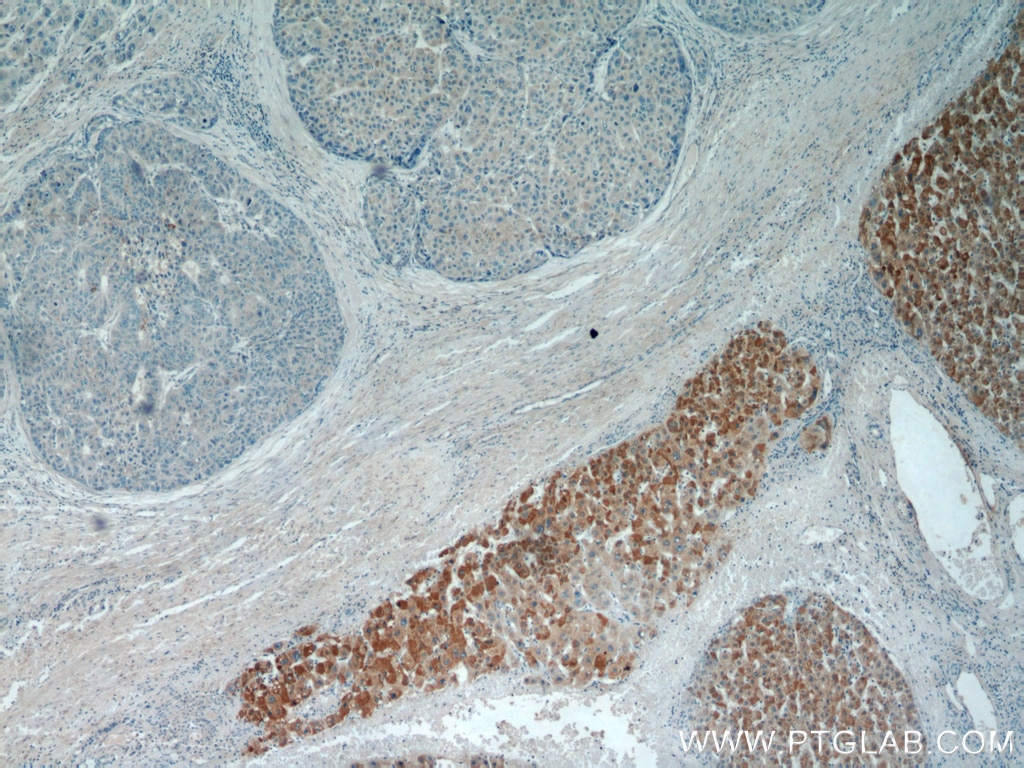 Immunohistochemistry (IHC) staining of human liver cancer tissue using MRPL3 Polyclonal antibody (16584-1-AP)