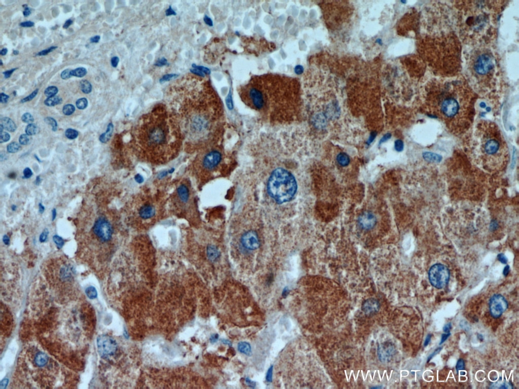 Immunohistochemistry (IHC) staining of human liver cancer tissue using MRPL3 Polyclonal antibody (16584-1-AP)