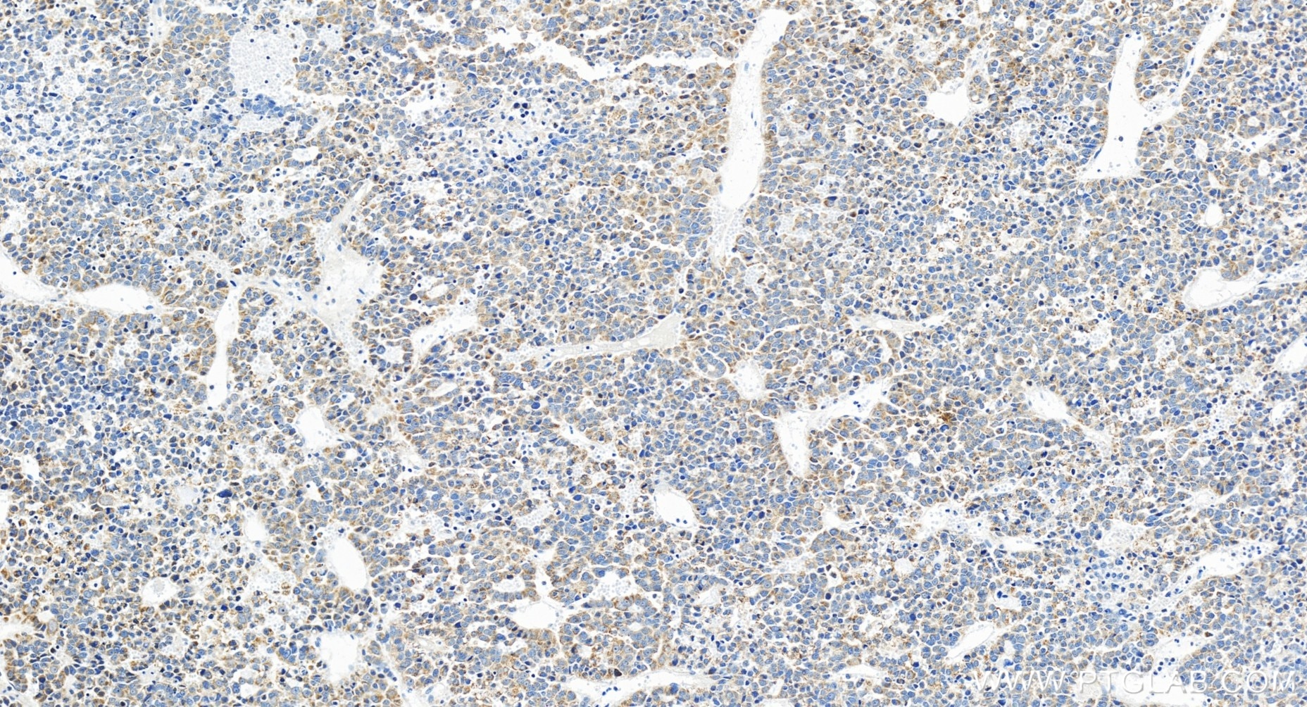 Immunohistochemistry (IHC) staining of human liver cancer tissue using MRPL3 Recombinant antibody (85327-1-RR)