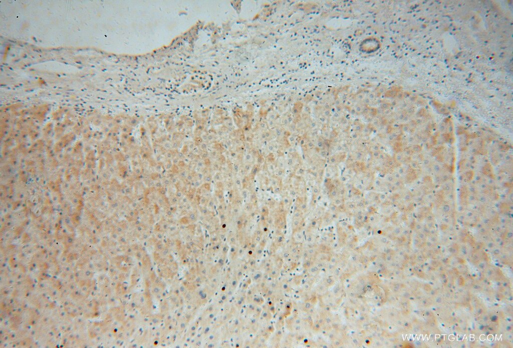 Immunohistochemistry (IHC) staining of human liver cancer tissue using MRPL34 Polyclonal antibody (15233-1-AP)