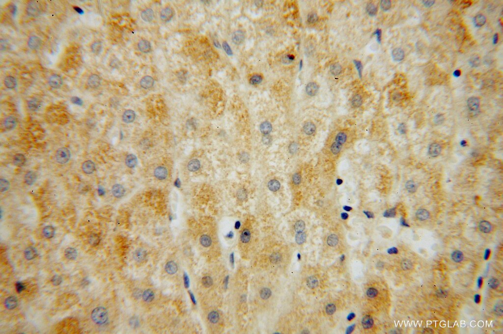 Immunohistochemistry (IHC) staining of human liver cancer tissue using MRPL34 Polyclonal antibody (15233-1-AP)