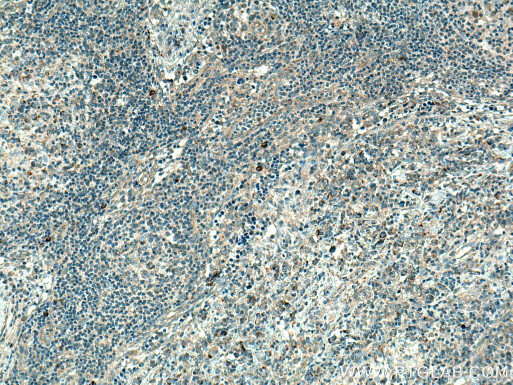 Immunohistochemistry (IHC) staining of human lymphoma tissue using MRPL37 Polyclonal antibody (15190-1-AP)