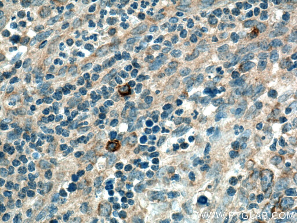 Immunohistochemistry (IHC) staining of human lymphoma tissue using MRPL37 Polyclonal antibody (15190-1-AP)