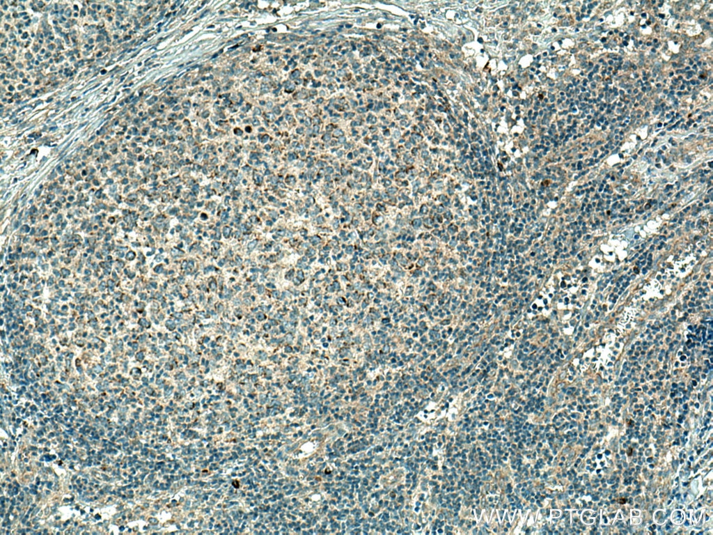 Immunohistochemistry (IHC) staining of human lymphoma tissue using MRPL37 Polyclonal antibody (15190-1-AP)