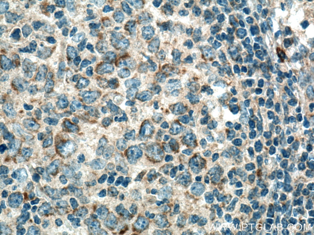 Immunohistochemistry (IHC) staining of human lymphoma tissue using MRPL37 Polyclonal antibody (15190-1-AP)