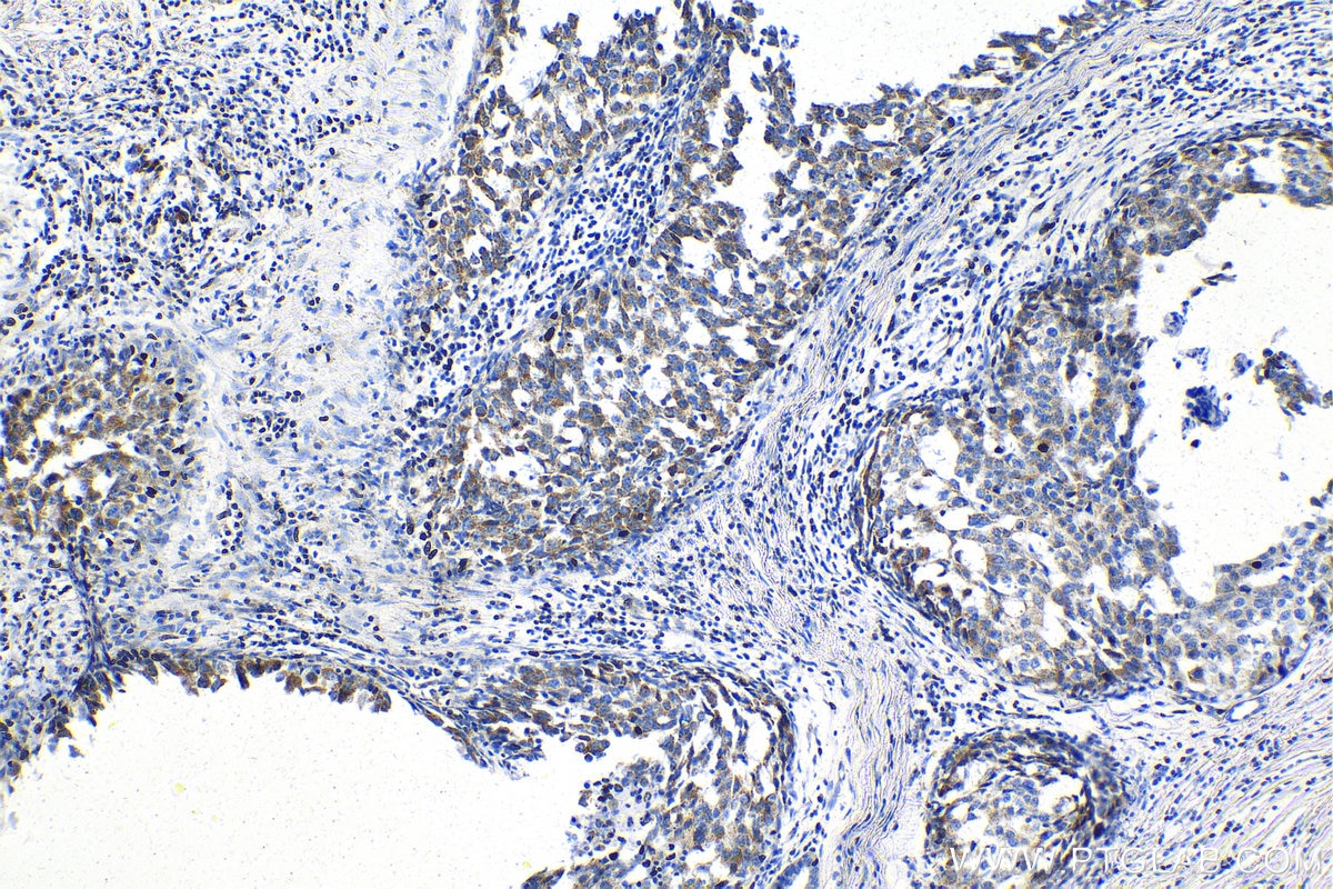 Immunohistochemistry (IHC) staining of human breast cancer tissue using MRPL42 Polyclonal antibody (17300-1-AP)