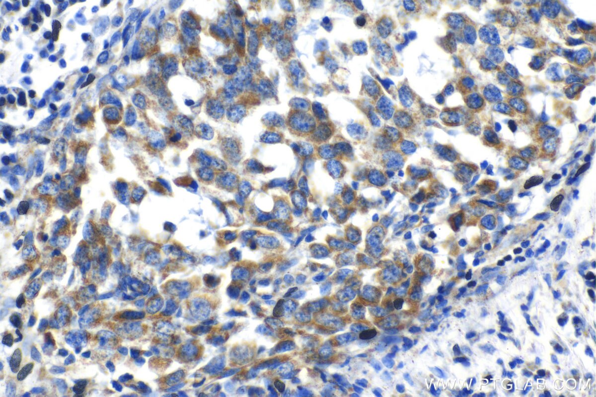 Immunohistochemistry (IHC) staining of human breast cancer tissue using MRPL42 Polyclonal antibody (17300-1-AP)