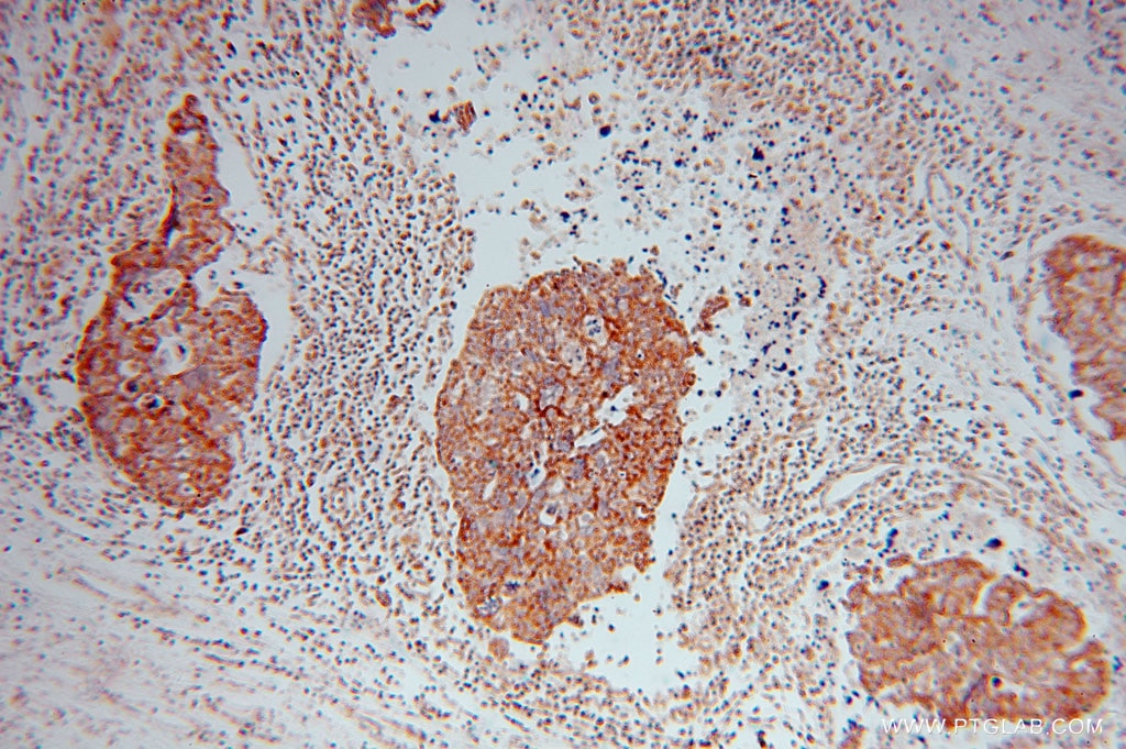 Immunohistochemistry (IHC) staining of human ovary tumor tissue using MRPL44 Polyclonal antibody (16394-1-AP)