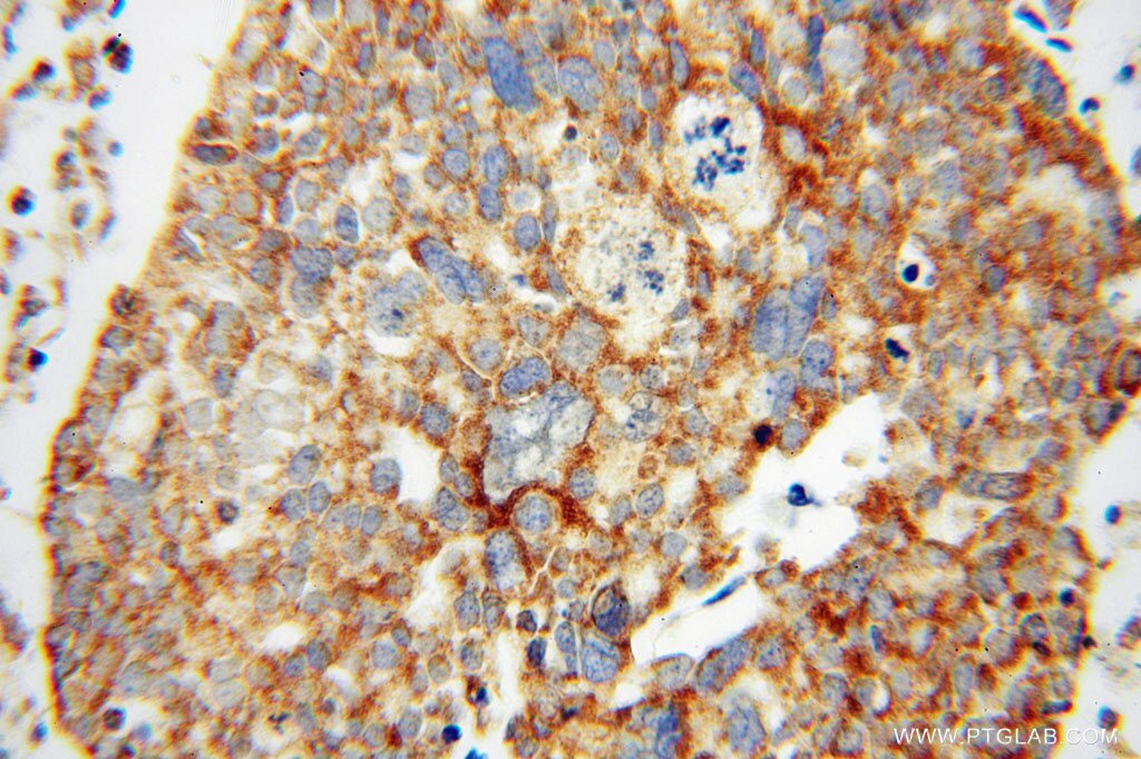 Immunohistochemistry (IHC) staining of human ovary tumor tissue using MRPL44 Polyclonal antibody (16394-1-AP)