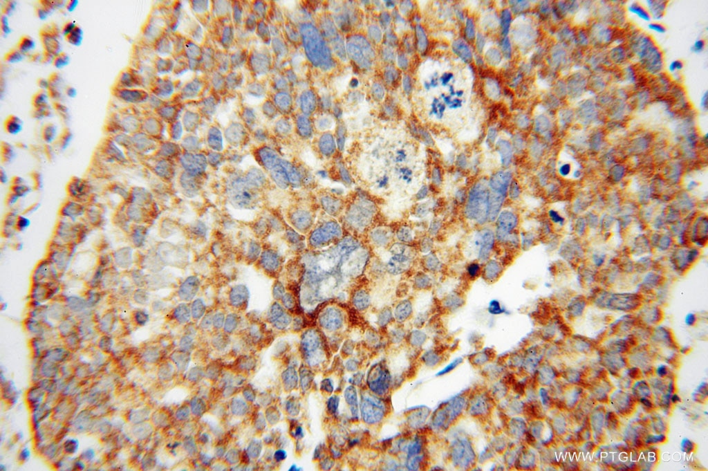 IHC staining of human ovary tumor using 16394-1-AP