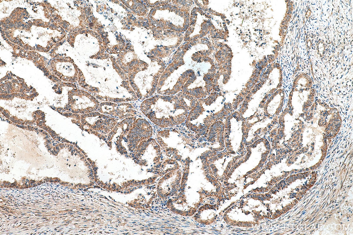 IHC staining of human ovary tumor using 15682-1-AP