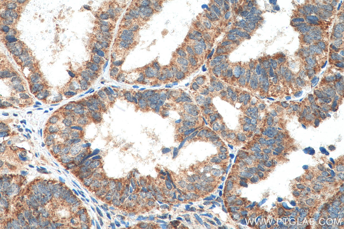 Immunohistochemistry (IHC) staining of human ovary tumor tissue using MRPL45 Polyclonal antibody (15682-1-AP)