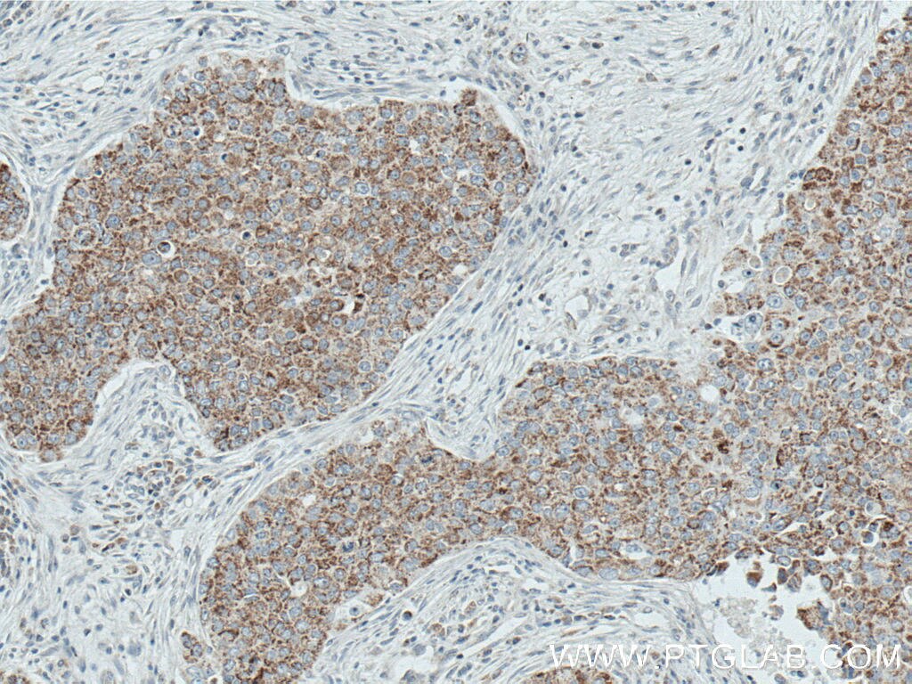 Immunohistochemistry (IHC) staining of human breast cancer tissue using MRPL45 Monoclonal antibody (66531-1-Ig)