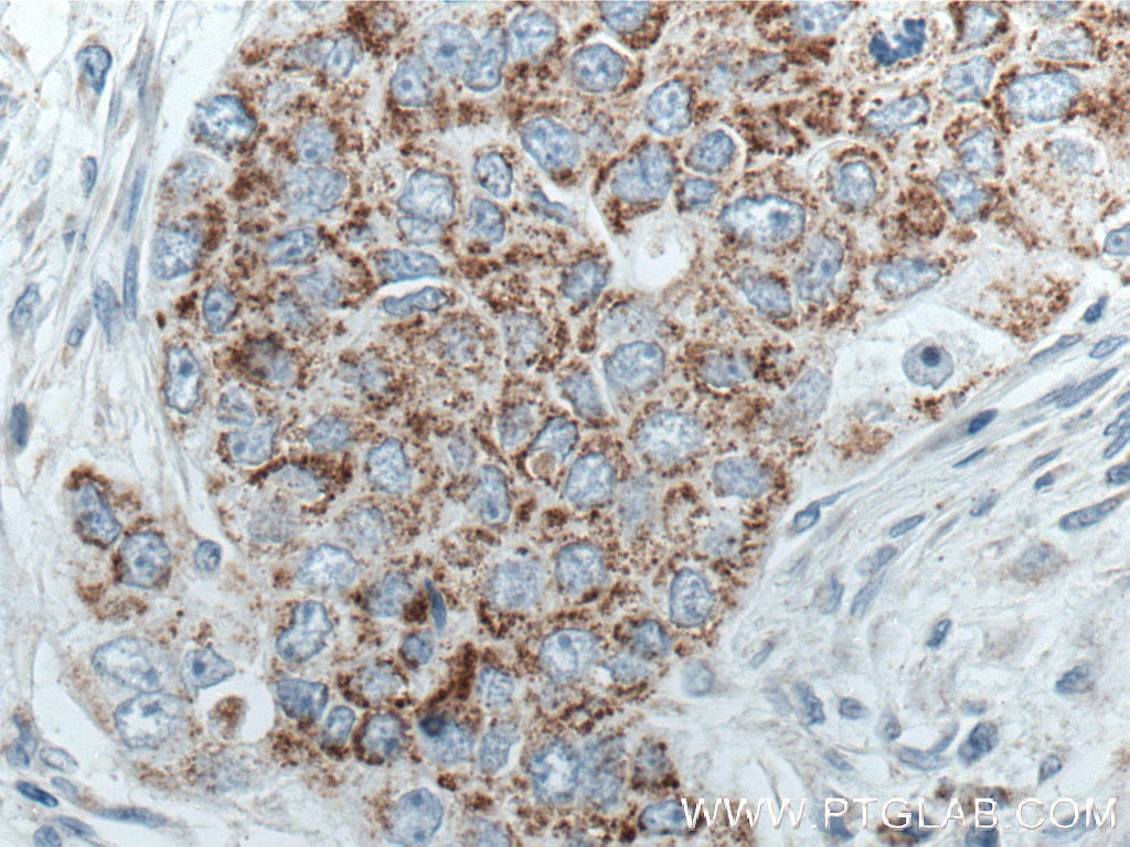 Immunohistochemistry (IHC) staining of human breast cancer tissue using MRPL45 Monoclonal antibody (66531-1-Ig)