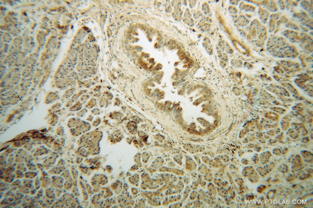 Immunohistochemistry (IHC) staining of human pancreas cancer tissue using MRPL48 Polyclonal antibody (14677-1-AP)
