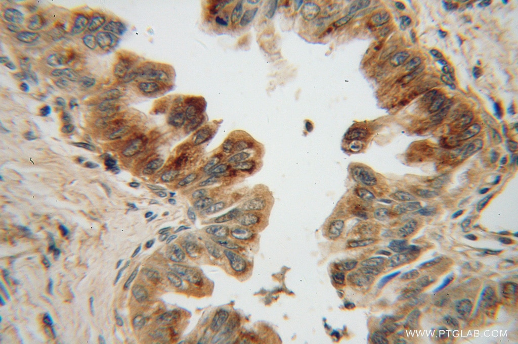 Immunohistochemistry (IHC) staining of human pancreas cancer tissue using MRPL48 Polyclonal antibody (14677-1-AP)