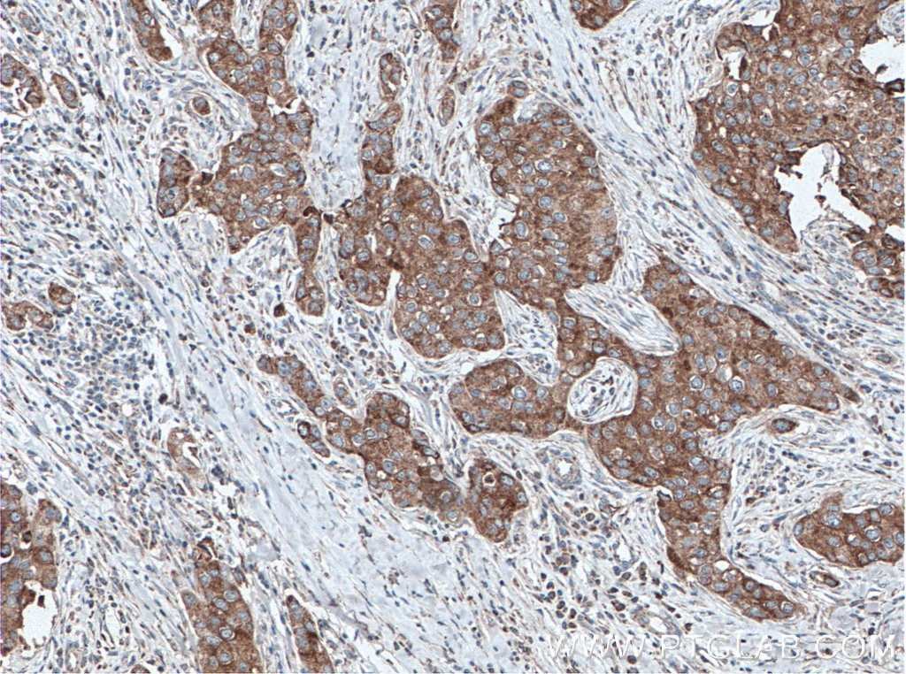Immunohistochemistry (IHC) staining of human breast cancer tissue using MRPL49 Polyclonal antibody (15542-1-AP)