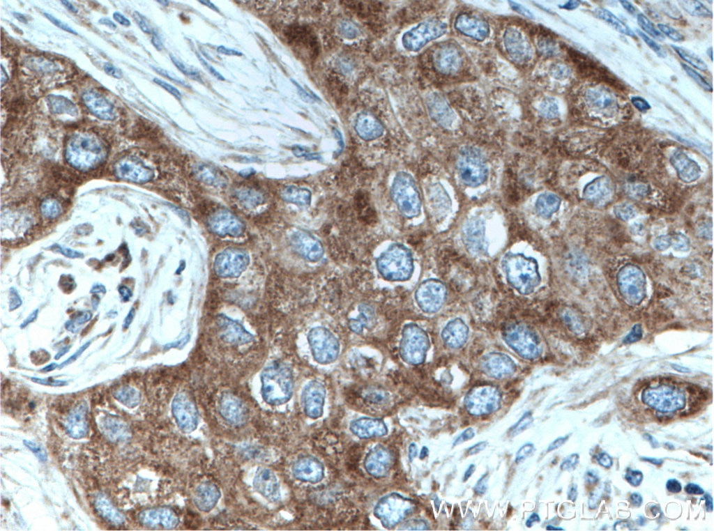 Immunohistochemistry (IHC) staining of human breast cancer tissue using MRPL49 Polyclonal antibody (15542-1-AP)