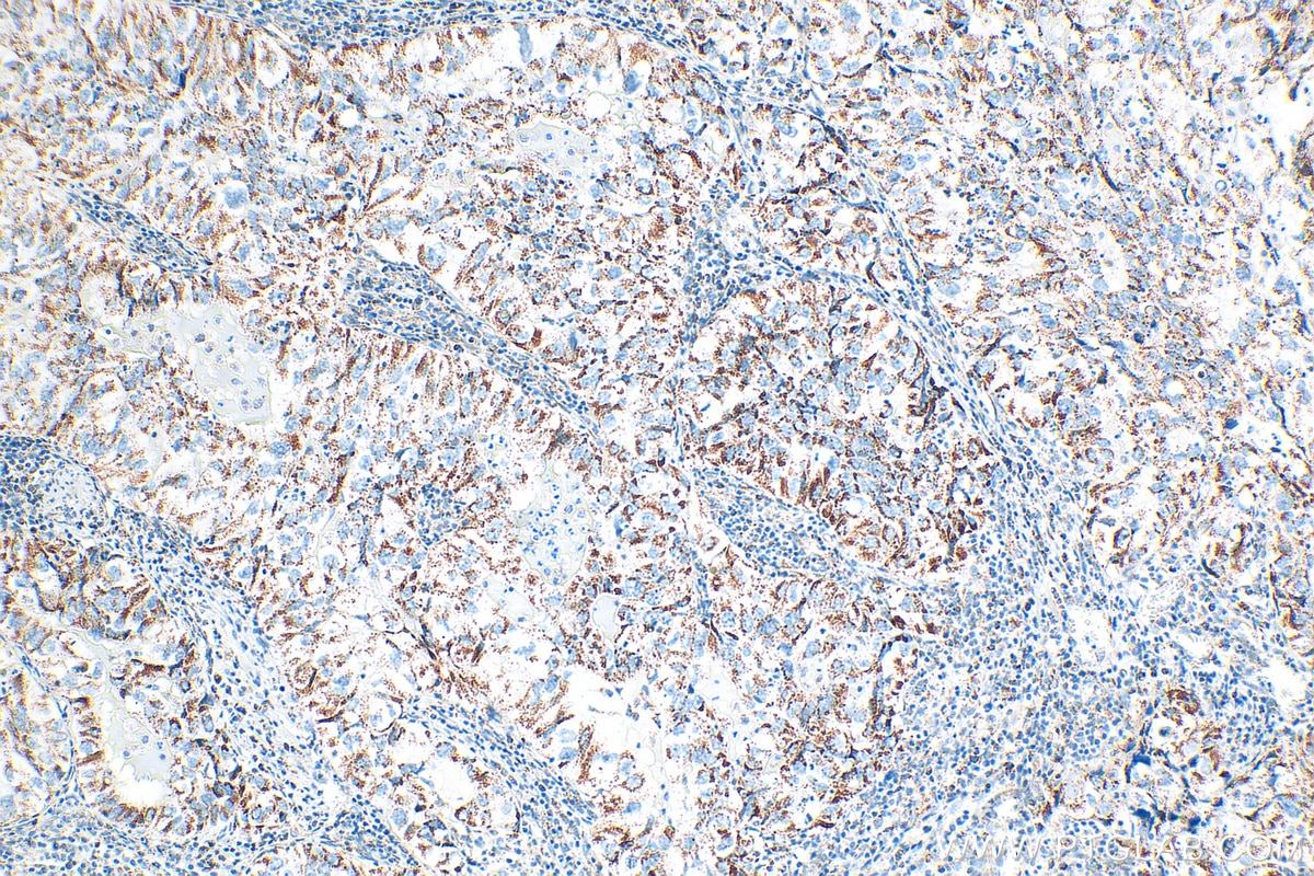 Immunohistochemistry (IHC) staining of human lung cancer tissue using MRPL51 Recombinant antibody (83565-1-RR)