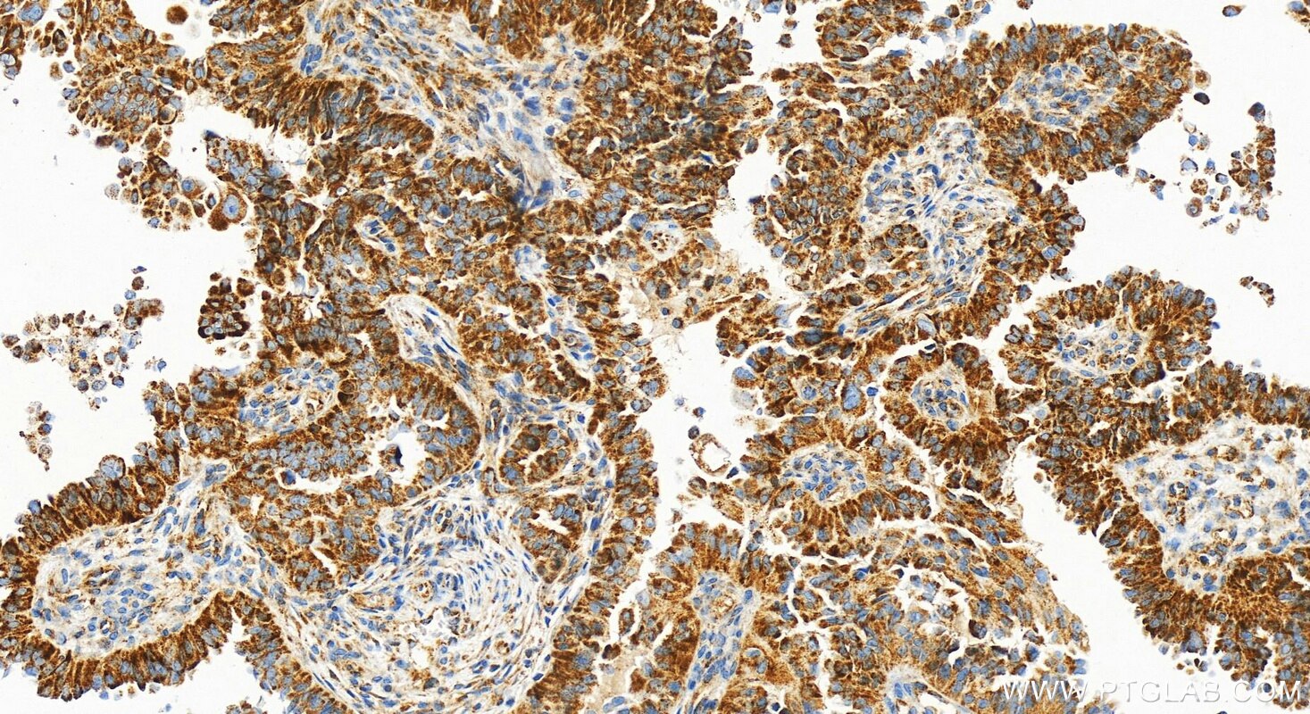 Immunohistochemistry (IHC) staining of human ovarian cancer using MRPL51 Recombinant antibody (83565-1-RR)