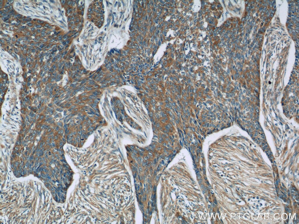 Immunohistochemistry (IHC) staining of human skin cancer tissue using MRPL53 Polyclonal antibody (16142-1-AP)