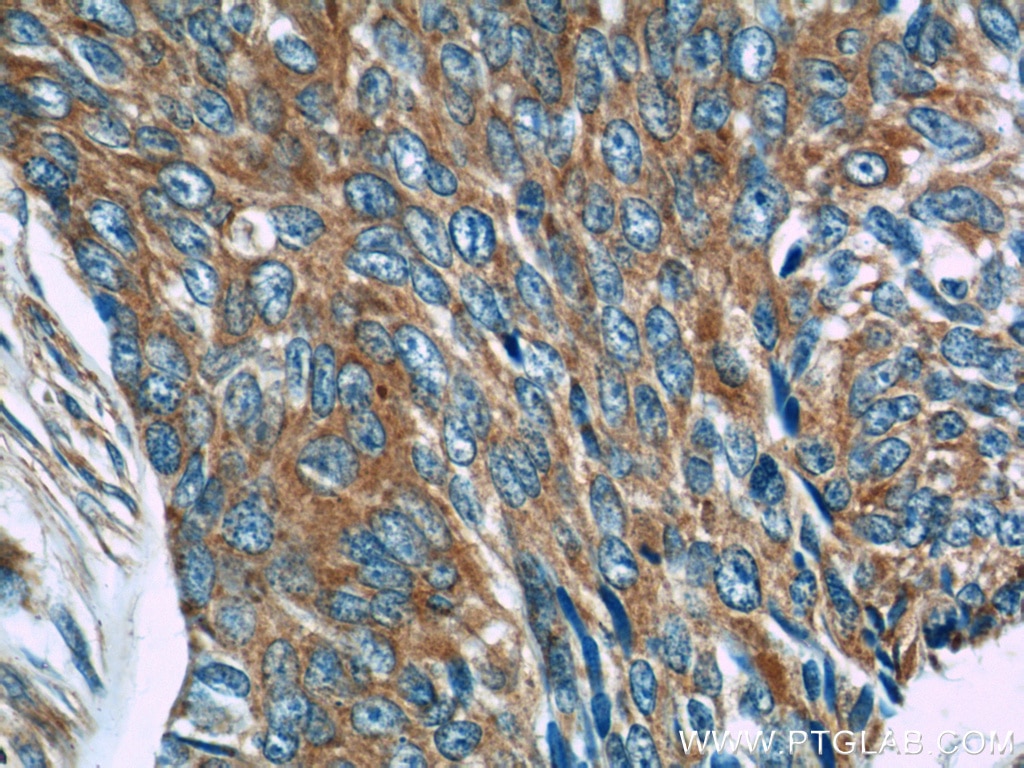 Immunohistochemistry (IHC) staining of human skin cancer tissue using MRPL53 Polyclonal antibody (16142-1-AP)