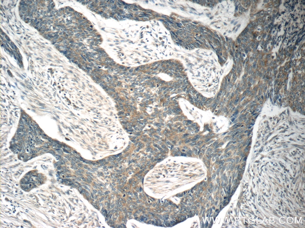 Immunohistochemistry (IHC) staining of human skin cancer tissue using MRPL54 Polyclonal antibody (17683-1-AP)