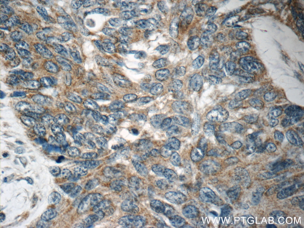 Immunohistochemistry (IHC) staining of human skin cancer tissue using MRPL54 Polyclonal antibody (17683-1-AP)