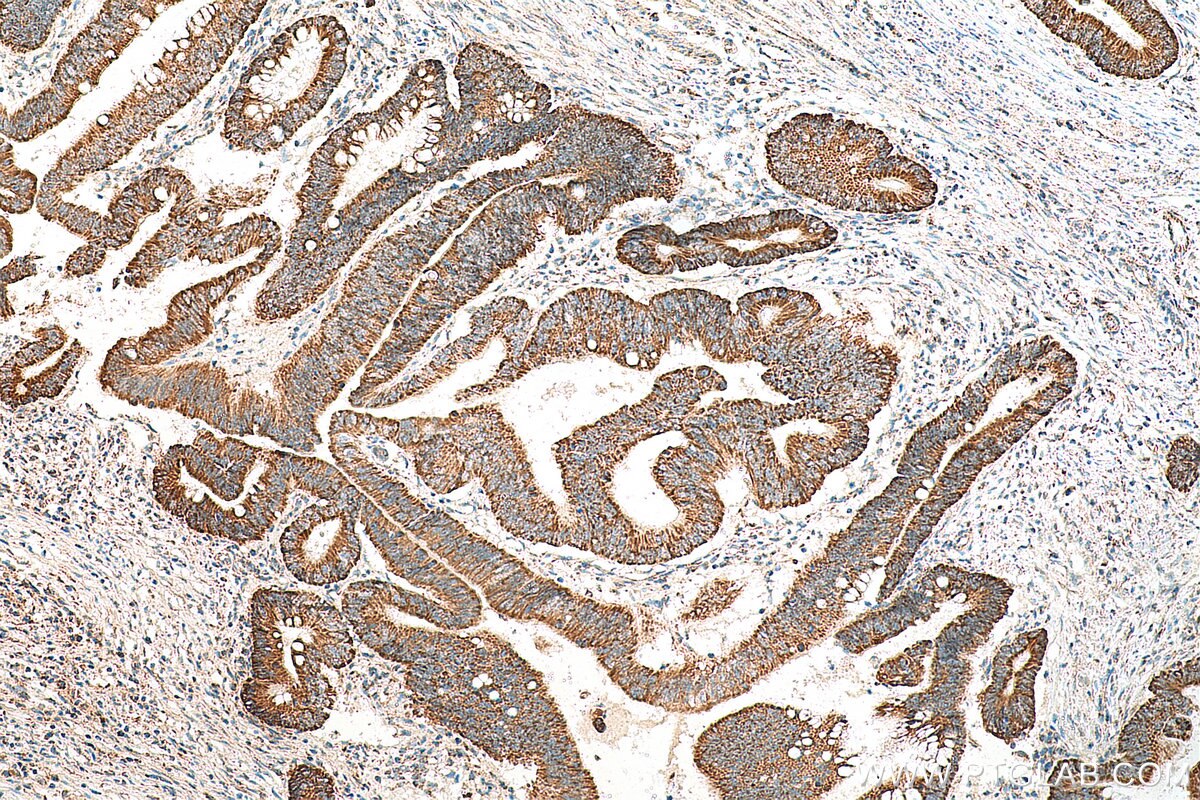 Immunohistochemistry (IHC) staining of human colon cancer tissue using MRPL55 Polyclonal antibody (17679-1-AP)