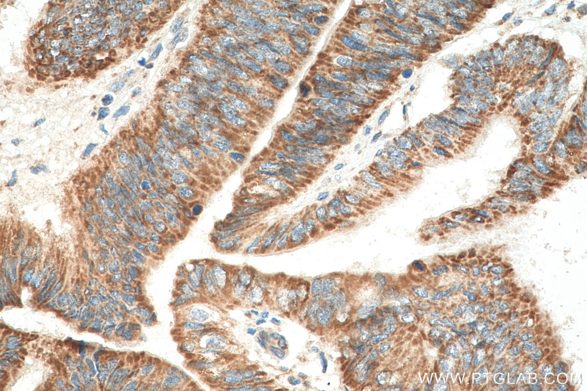 Immunohistochemistry (IHC) staining of human colon cancer tissue using MRPL55 Polyclonal antibody (17679-1-AP)