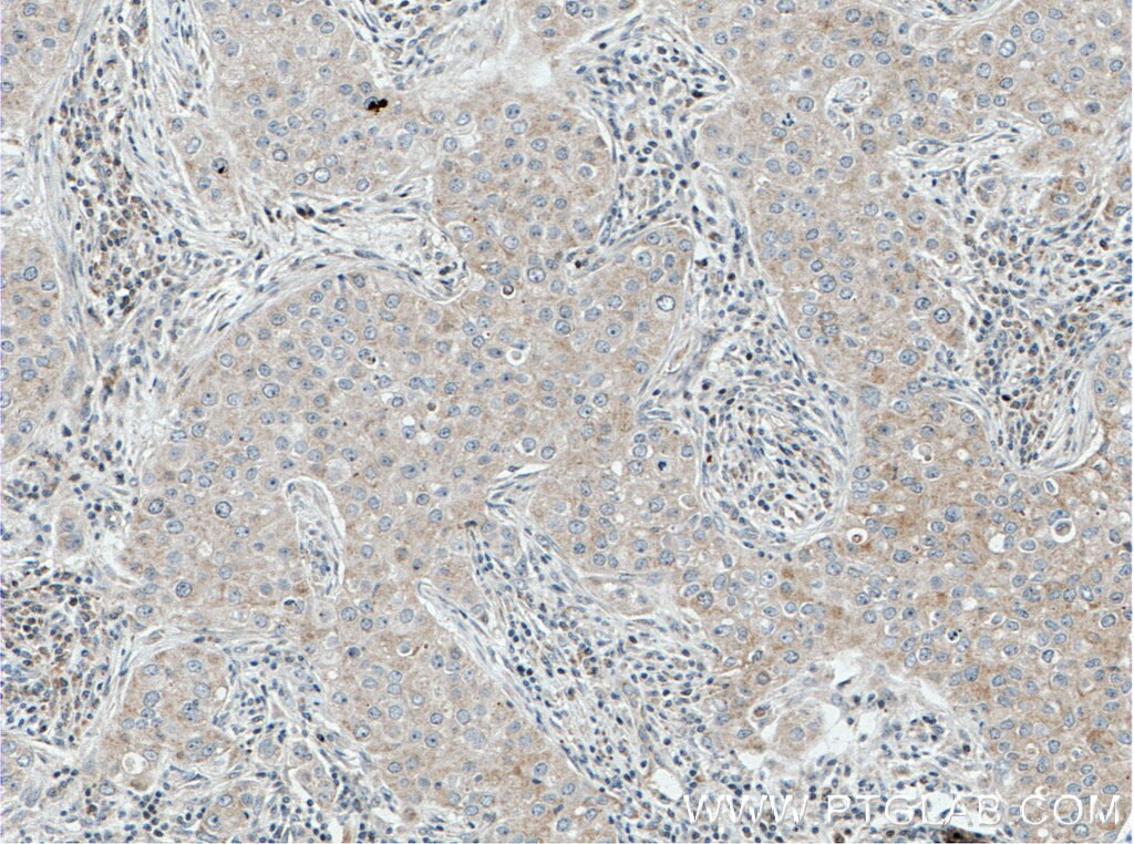Immunohistochemistry (IHC) staining of human breast cancer tissue using MRPL9 Polyclonal antibody (15342-1-AP)