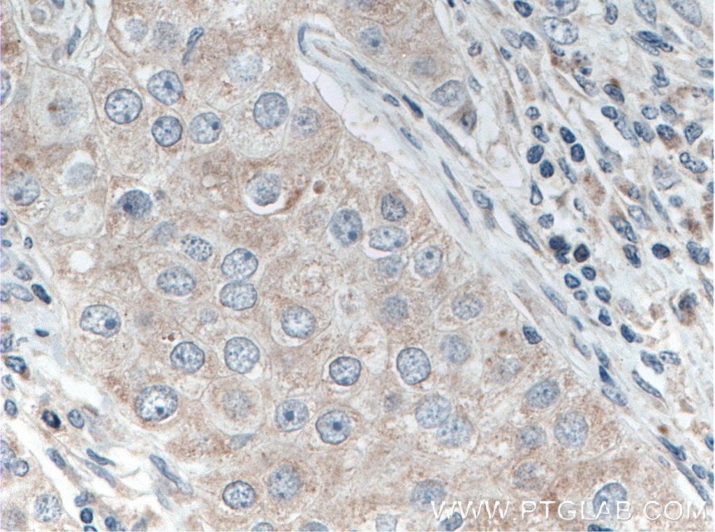 Immunohistochemistry (IHC) staining of human breast cancer tissue using MRPL9 Polyclonal antibody (15342-1-AP)