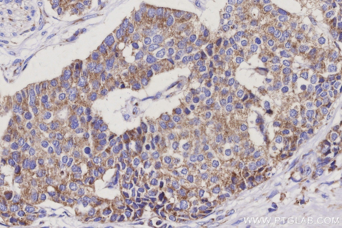 IHC staining of human stomach cancer using 16301-1-AP Immunohistochemistry (IHC) staining of human stomach cancer tissue using MRPS14 Polyclonal antibody (16301-1-AP)