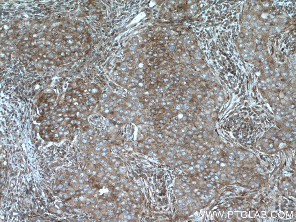 Immunohistochemistry (IHC) staining of human breast cancer tissue using MRPS18B Polyclonal antibody (16139-1-AP)