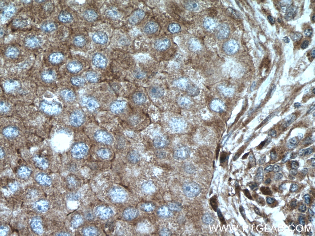 Immunohistochemistry (IHC) staining of human breast cancer tissue using MRPS18B Polyclonal antibody (16139-1-AP)