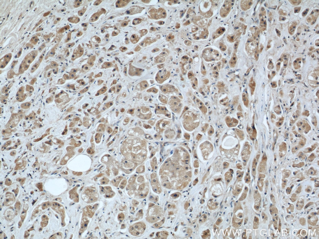 Immunohistochemistry (IHC) staining of human breast cancer tissue using MRPS18B Polyclonal antibody (16139-1-AP)