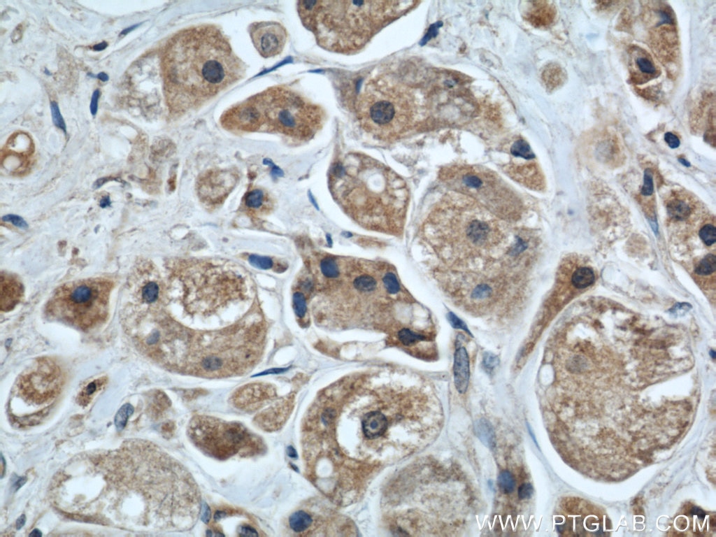 Immunohistochemistry (IHC) staining of human breast cancer tissue using MRPS18B Polyclonal antibody (16139-1-AP)