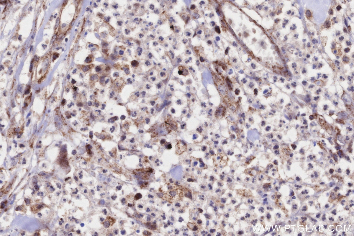 Immunohistochemistry (IHC) staining of human colon cancer tissue using MRPS22 Polyclonal antibody (10984-1-AP)