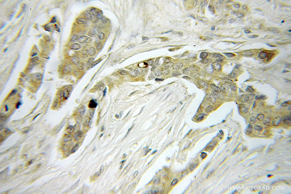 Immunohistochemistry (IHC) staining of human breast cancer tissue using MRPS22 Polyclonal antibody (10984-1-AP)