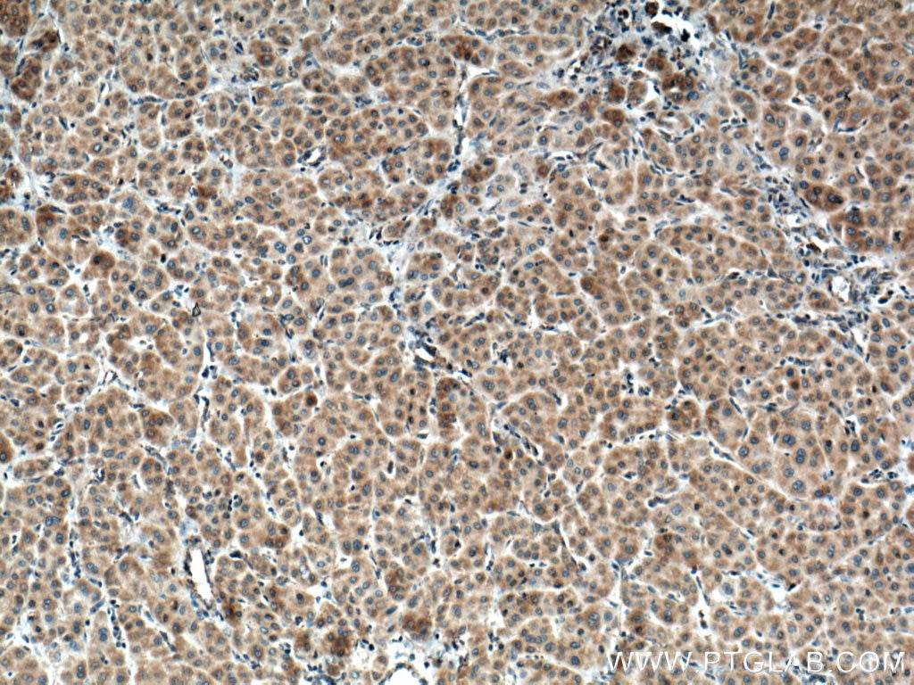 Immunohistochemistry (IHC) staining of human liver cancer tissue using MRPS23 Polyclonal antibody (18345-1-AP)