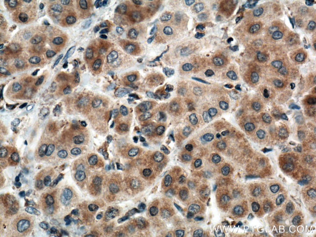 Immunohistochemistry (IHC) staining of human liver cancer tissue using MRPS23 Polyclonal antibody (18345-1-AP)