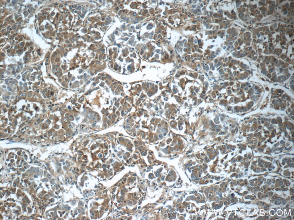 Immunohistochemistry (IHC) staining of human liver cancer tissue using MRPS26 Polyclonal antibody (15989-1-AP)